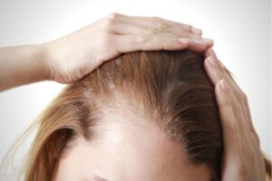 Hair Loss | Hair Thinning Problem