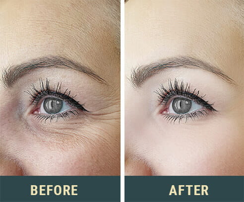 seriskin before after